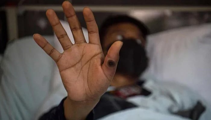 This file photo shows a patient showing his hand with a sore caused by an infection of the mpox virus. — AFP