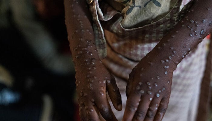 An mpox affected childs hands seen in this image.— AFP/file