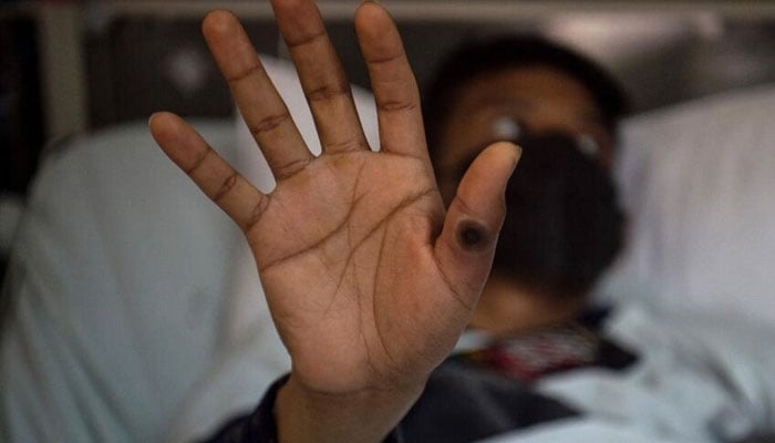 This file photo shows a patient showing his hand with a sore caused by an infection of the mpox virus. — AFP