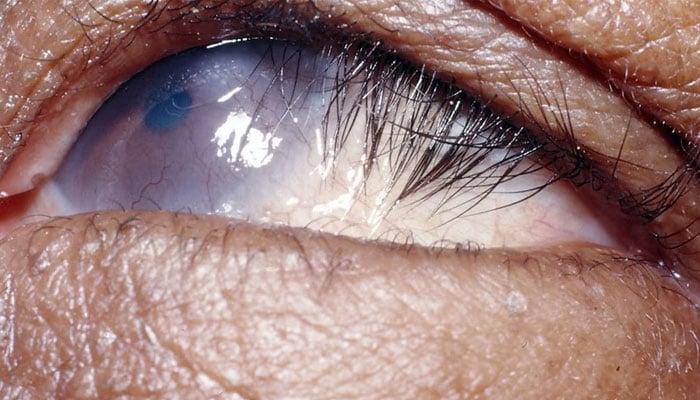 A close up image of an eye.— International Centre for Eye Health/file