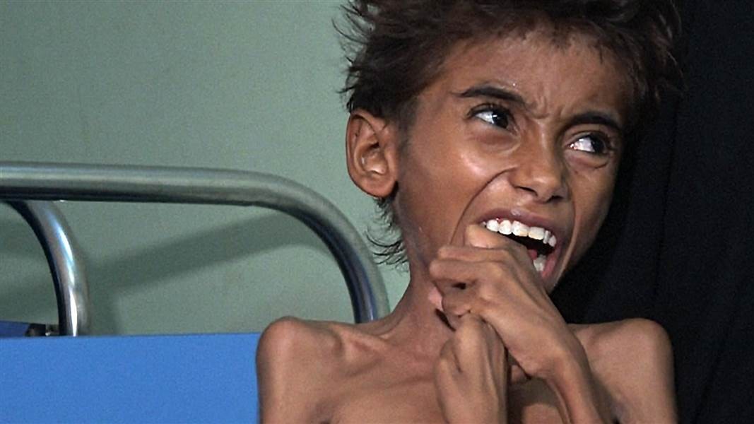 Starving Yemen