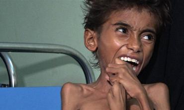 Starving Yemen