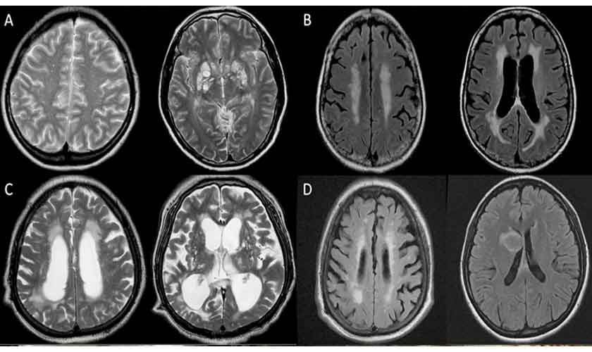 Understanding meningo-encephalitis | Political Economy | thenews.com.pk