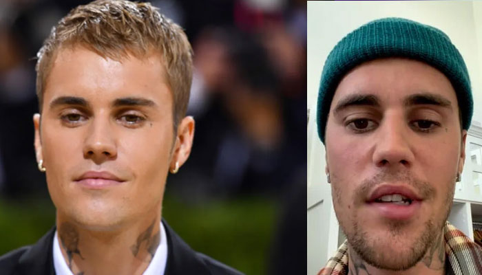 Health experts recommended treatment for Justin Bieber’s facial paralysis