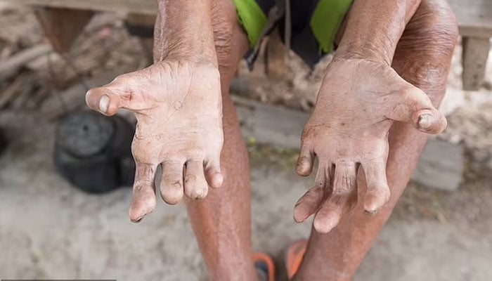 Alarm raised over rising cases of leprosy in Florida. Representational image.