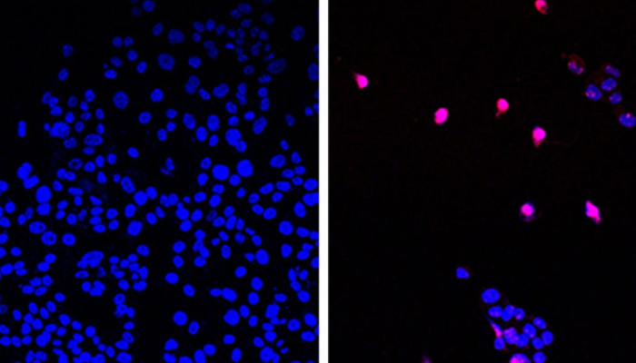 Untreated cancer cells are on the left, while cells treated with the new drug can be seen on the right. — City of Hope