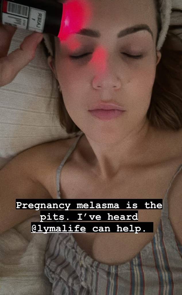 Mandy Moore opens up about her struggle with melasma during third pregnancy