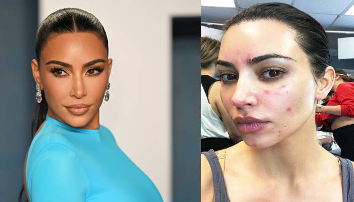 Kim Kardashian reveals psoriasis issue ruined Met Gala appearance