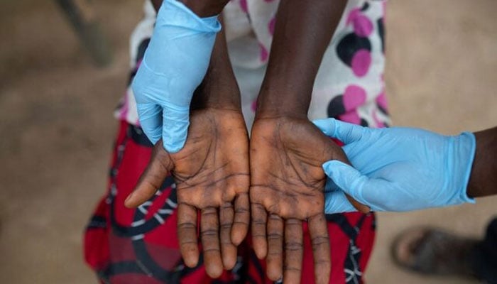 A doctor examines lesions on the hands of a person, who is suffering from monkeypox, in Yakusu, Tshopo, Democratic Republic of the Congo, October 2, 2022. — Reuters