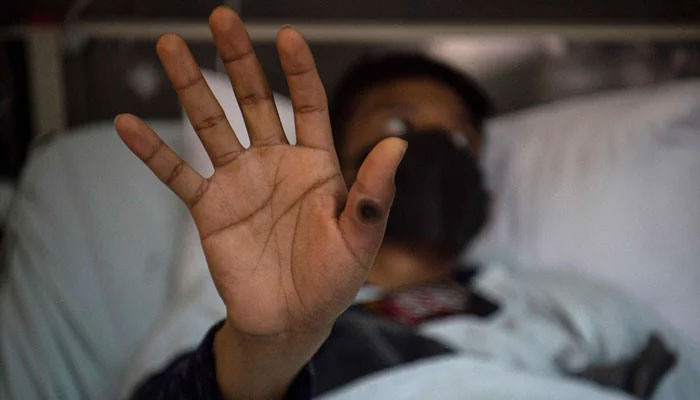 A representational image showing a patient showing his hand with a sore caused by an infection of the mpox virus, in the isolation area for mpox patients. — AFP/File