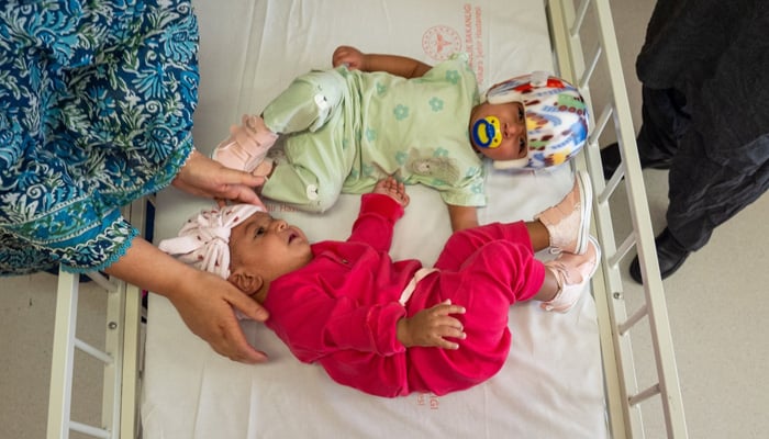 Pakistani conjoined twin girls, Mirha and Minal, separate after successful surgery by Turkish doctors at Bilkent City Hospital, Ankara. — Anadolu Agency