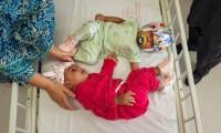 Pakistani Conjoined Twins Successfully Separated By Turkish Doctors