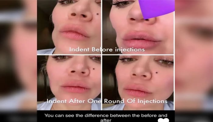 Khloe Kardashian reçoit des produits de comblement pour le visage et partage des photos après l'ablation de la tumeur